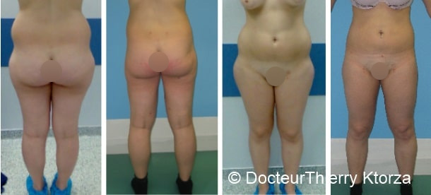 Existe-t-il des traitements alternatifs à la liposuccion?