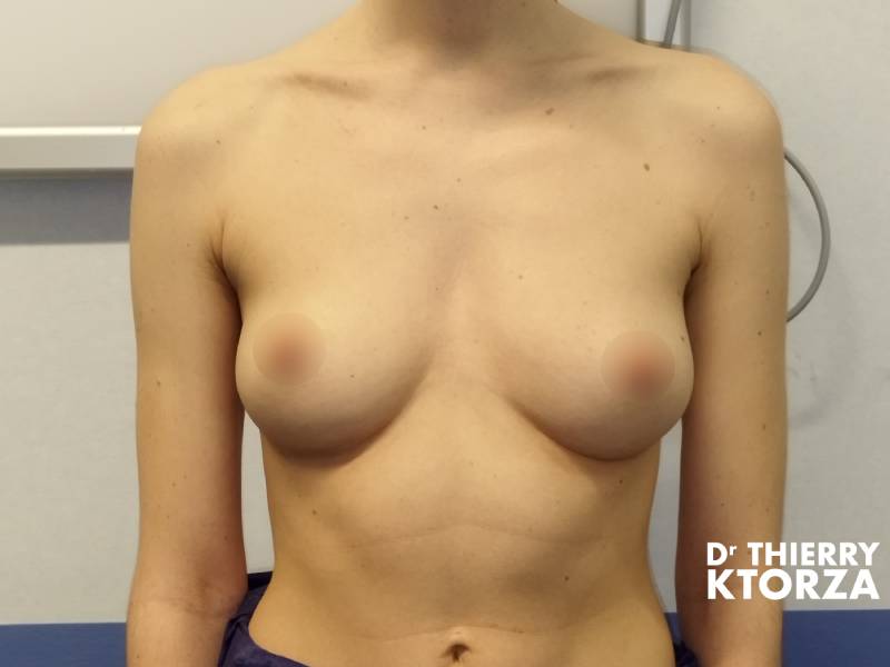 Résultats photo avant une augmentation mammaire avec prothèses (275 cc).