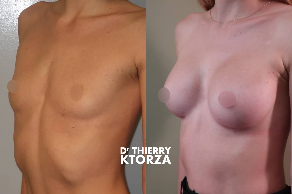 augmentation mammaire avant apres ktorza