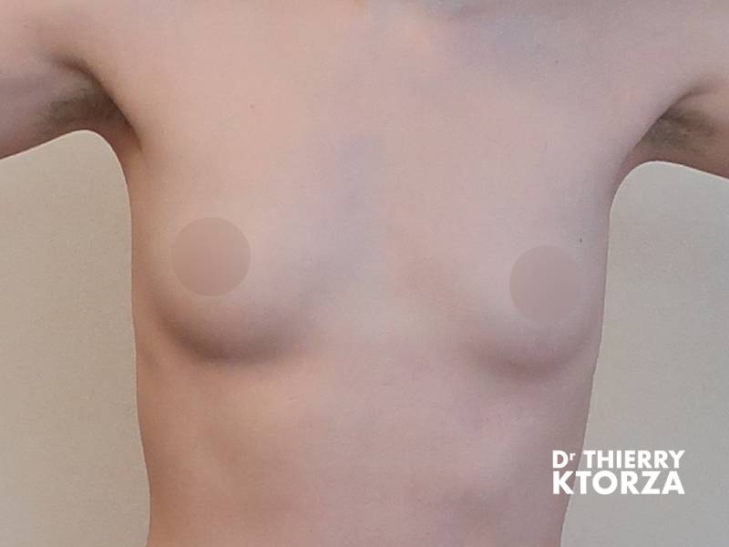 augmentation mammaire lipofilling avant ktorza