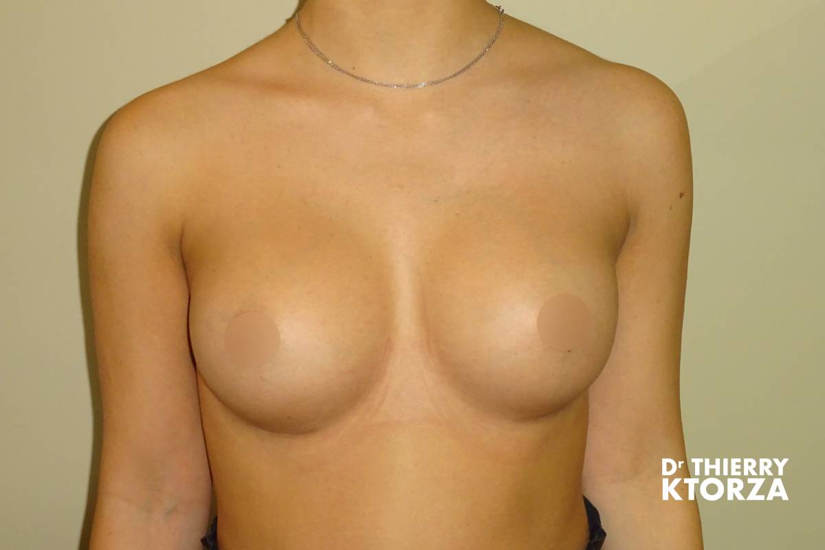 augmentation mammaire photo apres 10