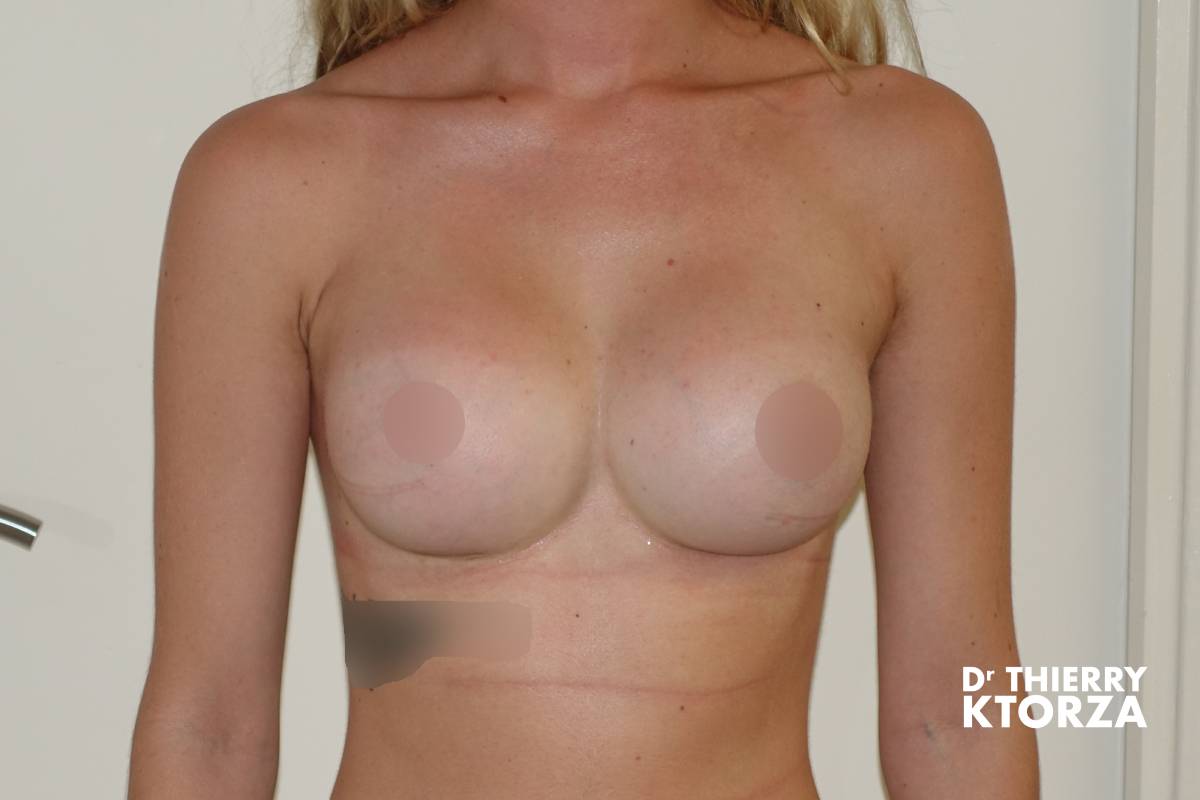 augmentation mammaire photo apres 11