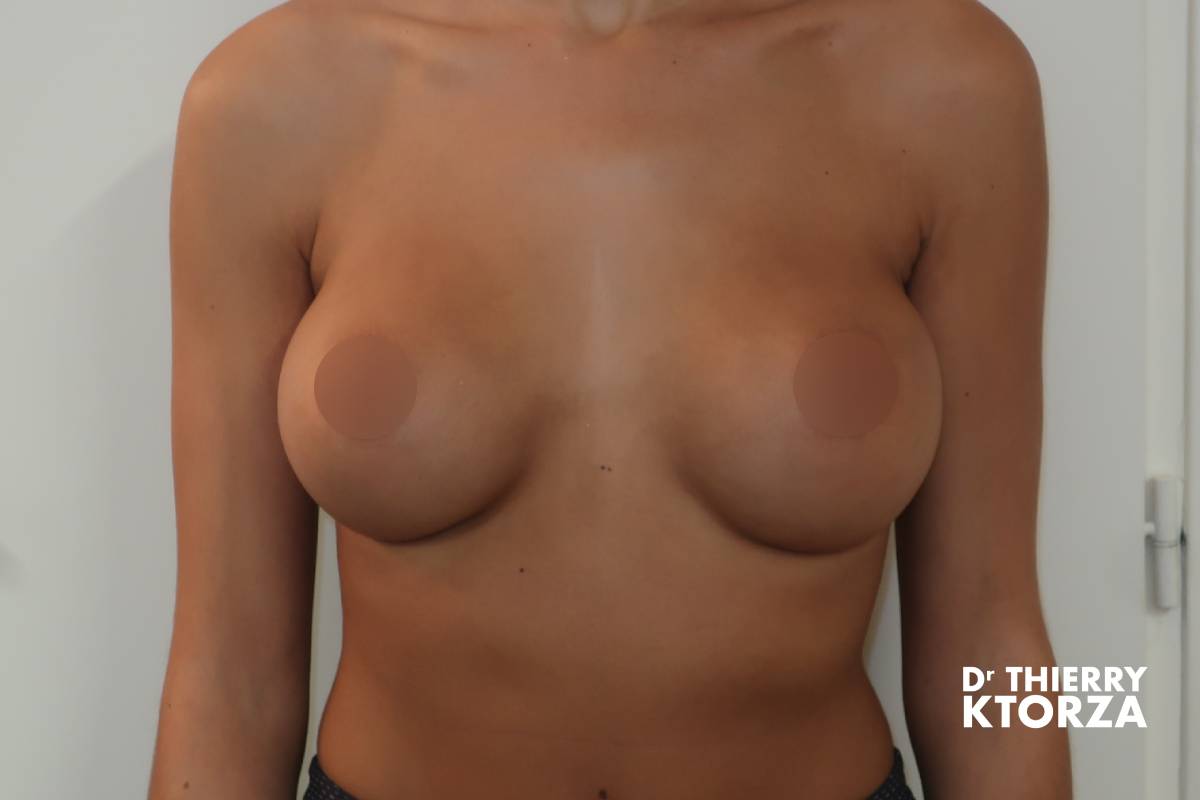 augmentation mammaire photo apres 12