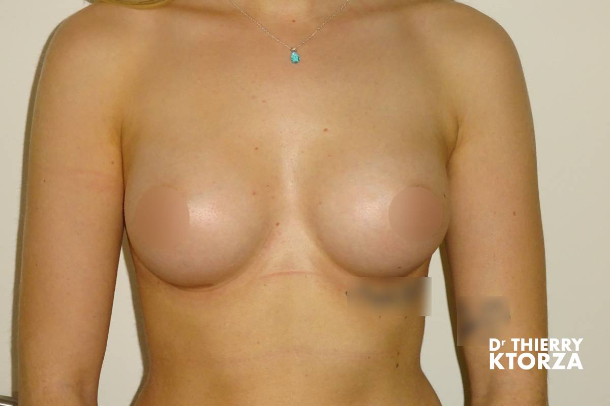 augmentation mammaire photo apres 4