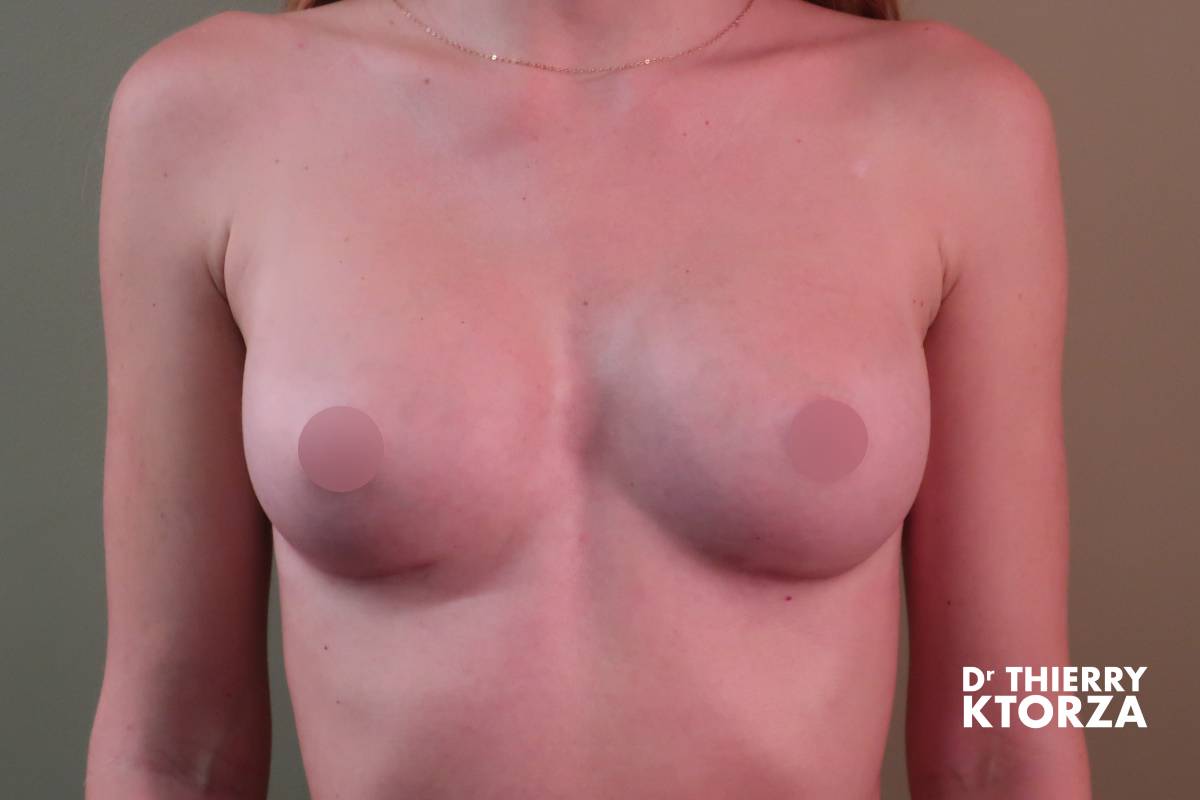 augmentation mammaire photo apres 8