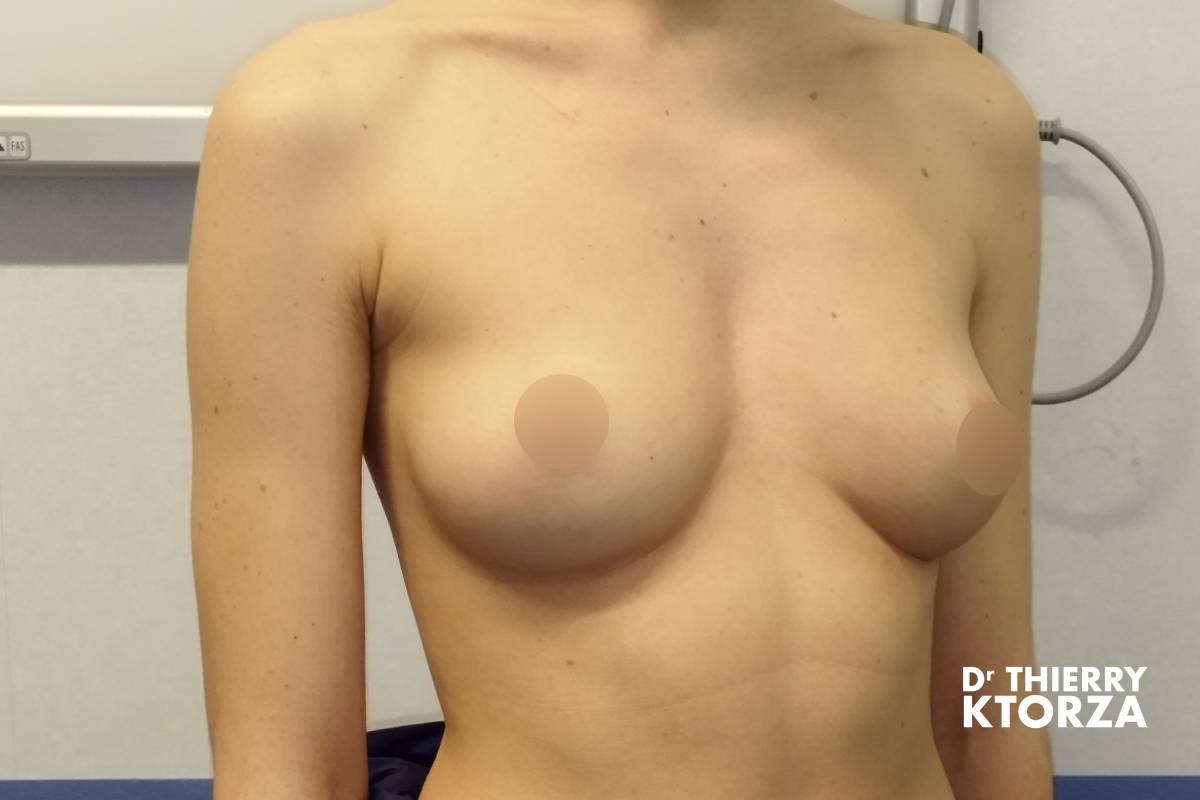 augmentation mammaire photo avant 9