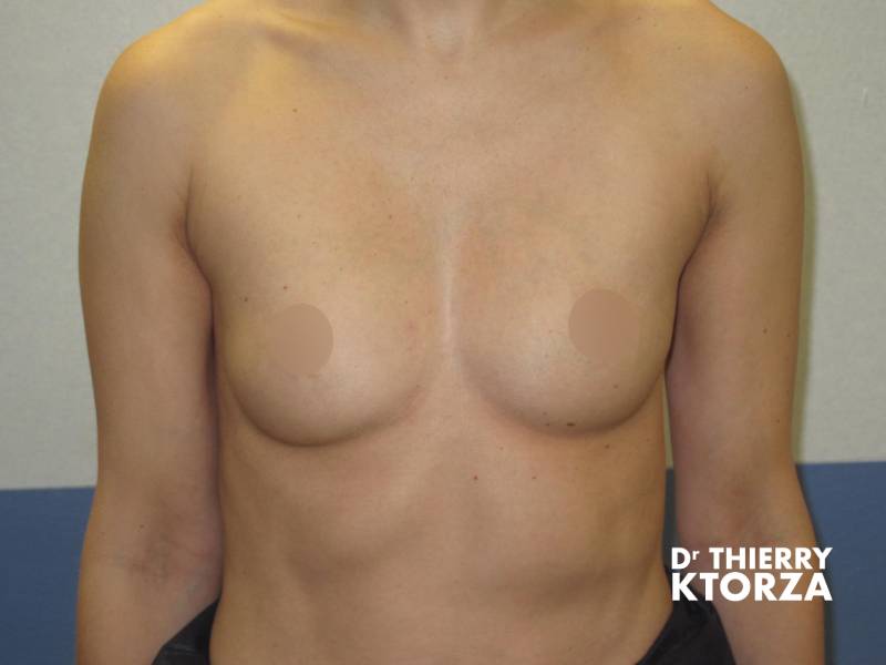 augmentation mammaire technique hybride avant ktorza