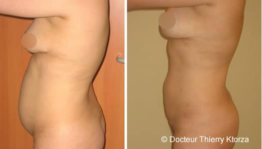 Comment obtenir un ventre plat grâce à la chirurgie esthétique ?