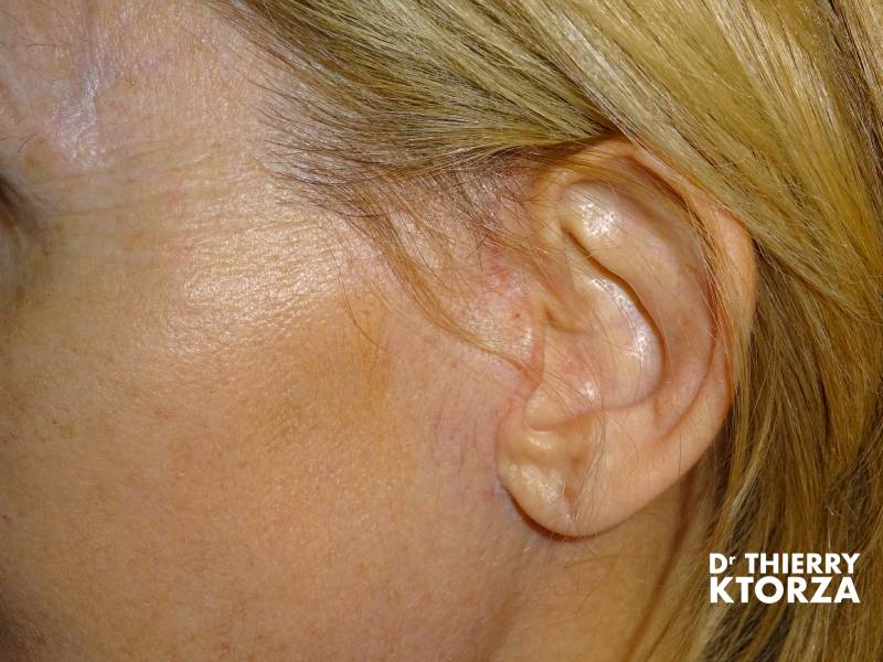 cicatrice lifting visage ktorza paris 1