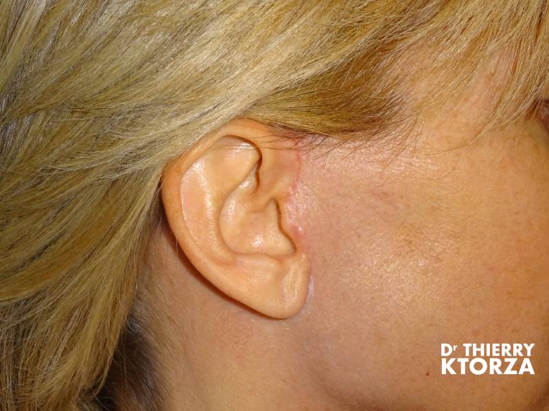 cicatrice lifting visage ktorza paris 2