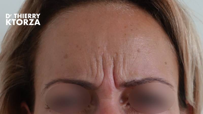 Botox efficace contre les rides d'expression (photo avant)
