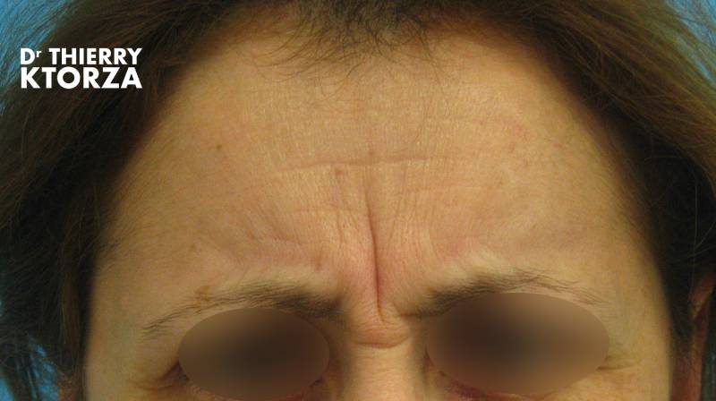 Botox Traitement anti-âge non chirurgical (photo avant)