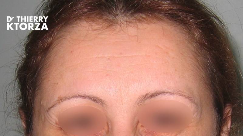 Botox Traitement anti-âge non chirurgical (photo après)
