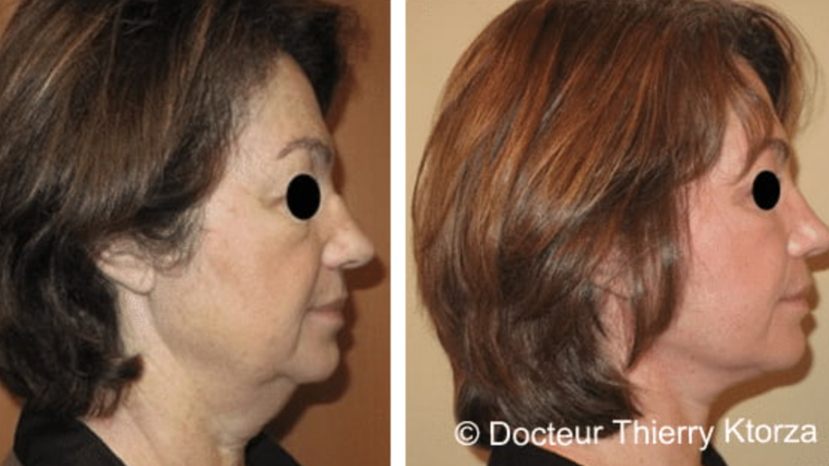 lifting blepharoplastie