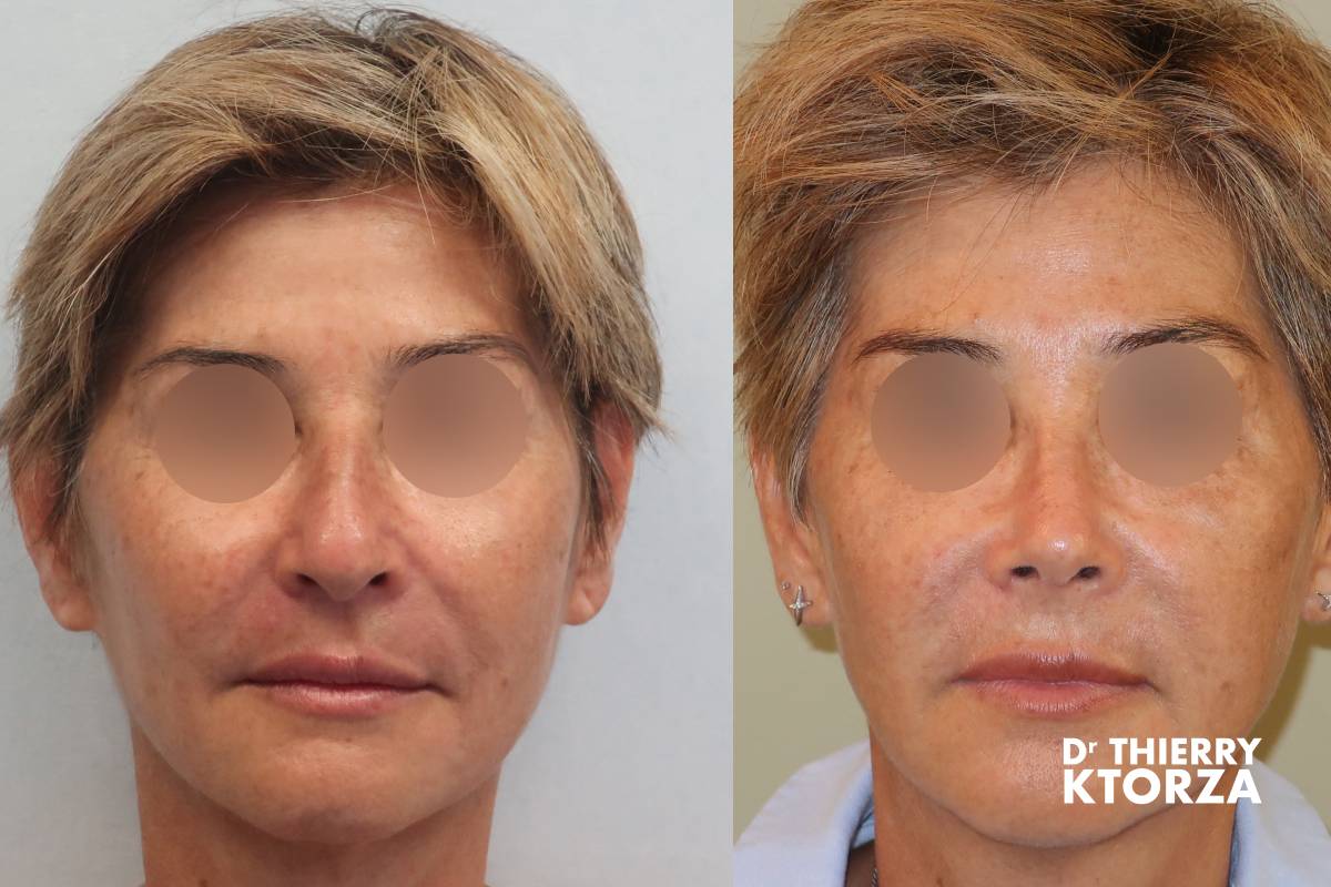 photo avant apres rhinoplastie preservation