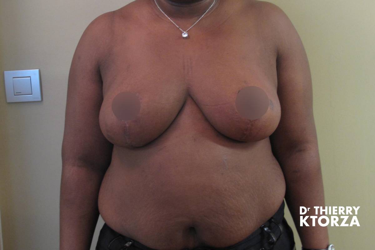 Résultats photo après une chirurgie de réduction mammaire (photo de face)