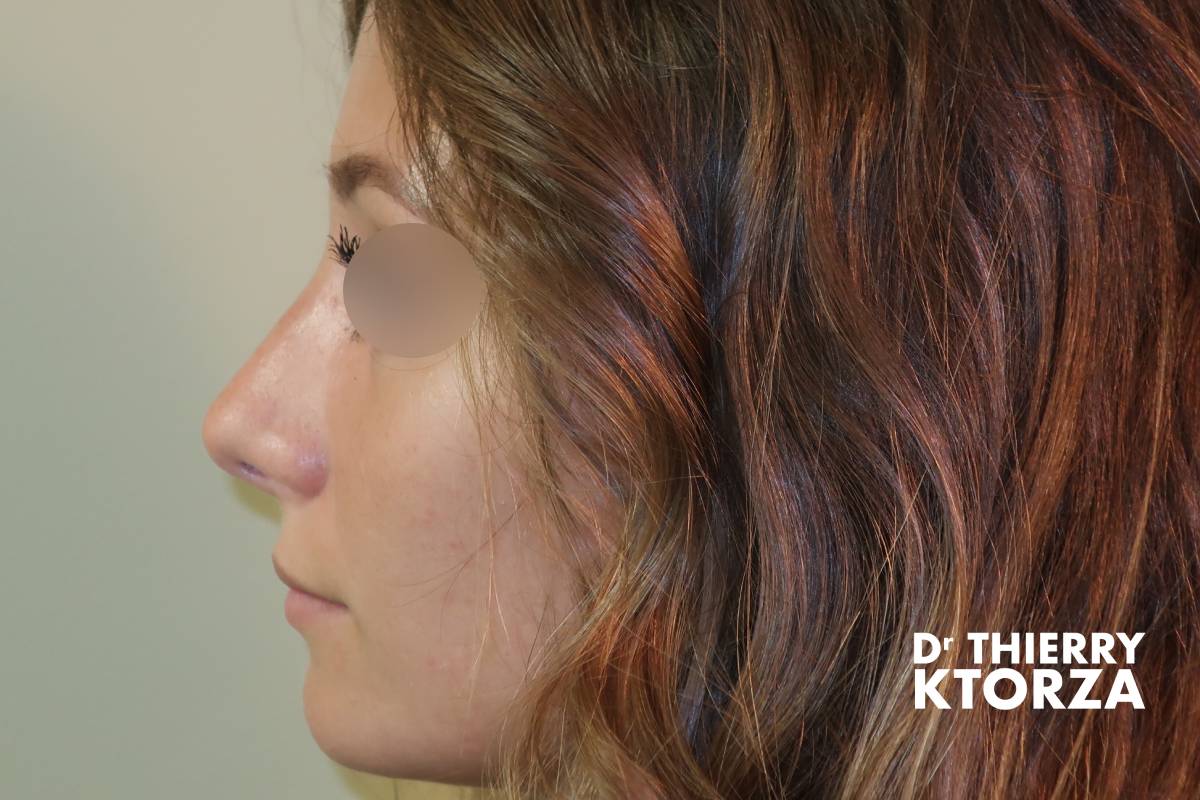 Patiente après une rhinoplastie (photo vue de profil)