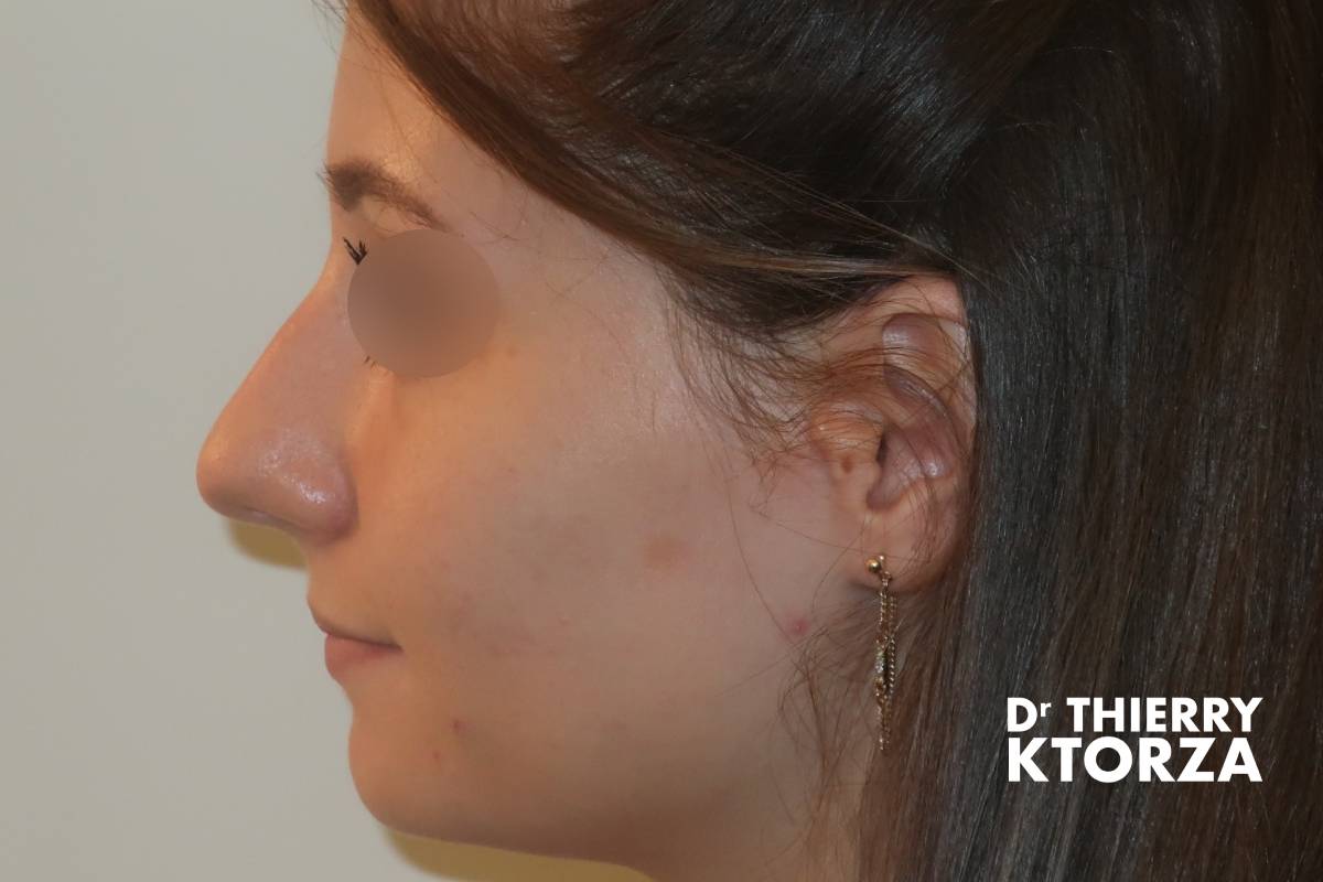 Patiente avant une rhinoplastie (photo vue de profil)