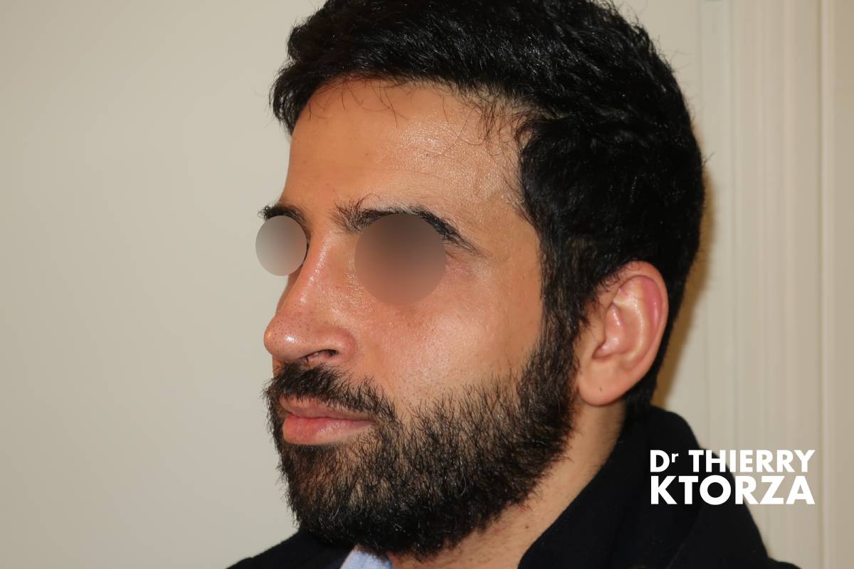 Résultat après une rhinoplastie secondaire (vue de trois-quart)