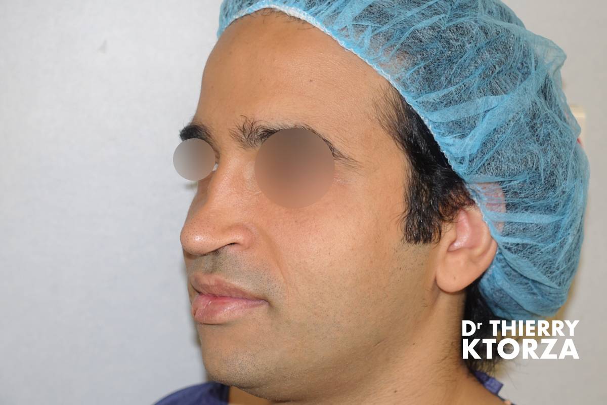 Photo avant une rhinoplastie secondaire (vue de trois-quart)
