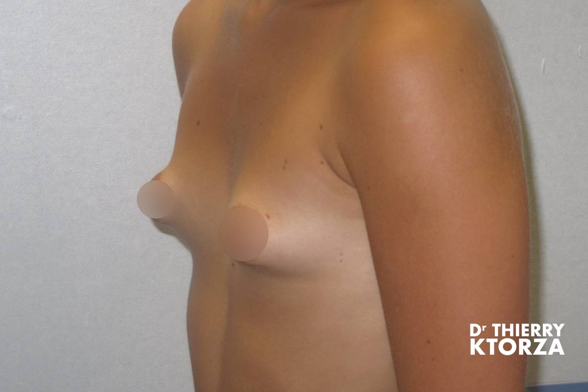 Résultats photo avant une chirurgie des seins tubéreux (photo de trois-quart)