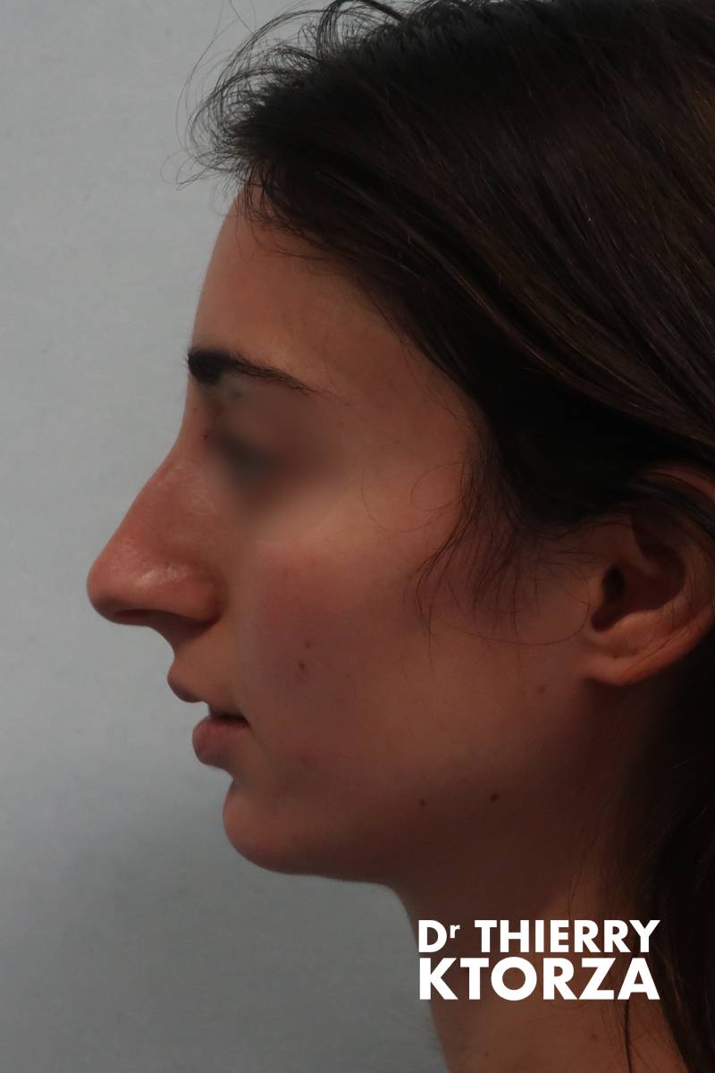 rhinoplastie adolescente avant