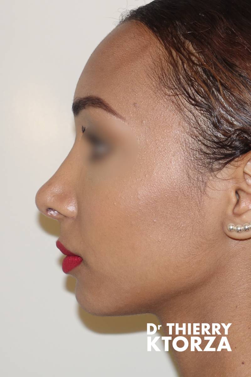 rhinoplastie adulte apres