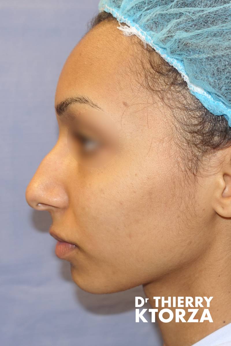 rhinoplastie adulte avant