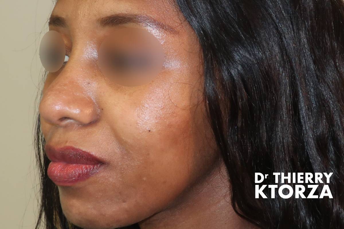 Patiente après une rhinoplastie ethnique africaine (photo vue de trois-quart)