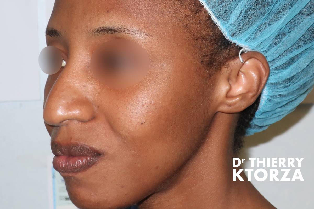 Patiente avant une rhinoplastie ethnique africaine (photo vue de trois-quart)