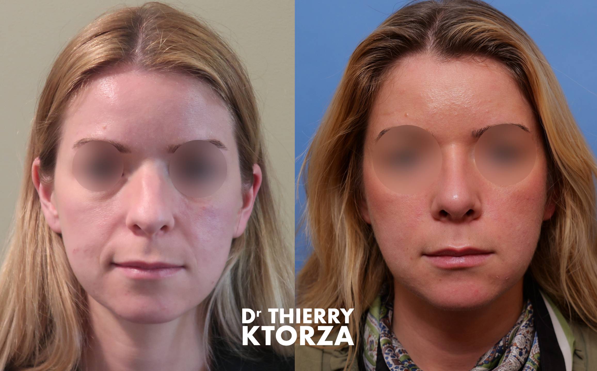 rhinoplastie ktorza post