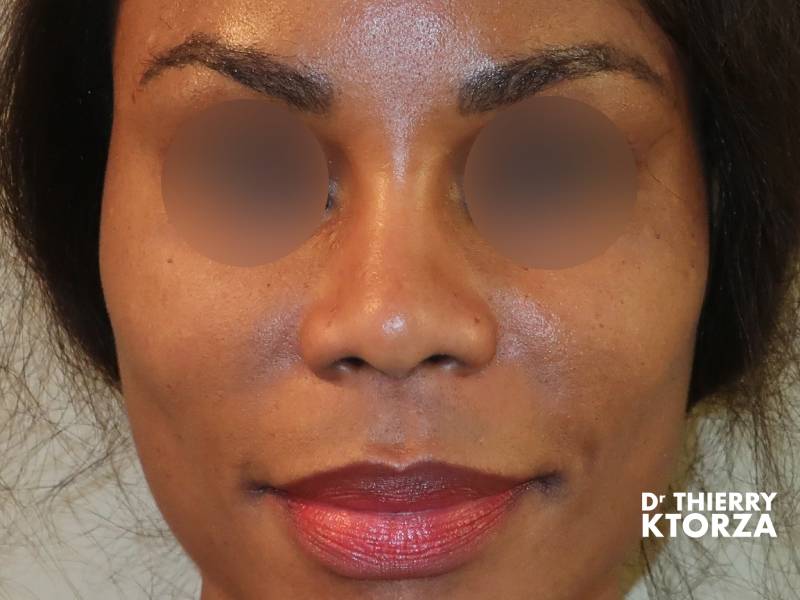 Résultats attendus après une rhinoplastie médicale (photo après, vue de face)
