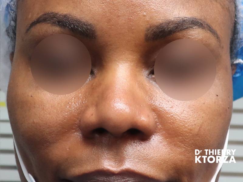 Patiente avant une rhinoplastie médicale (photo avant, vue de face)