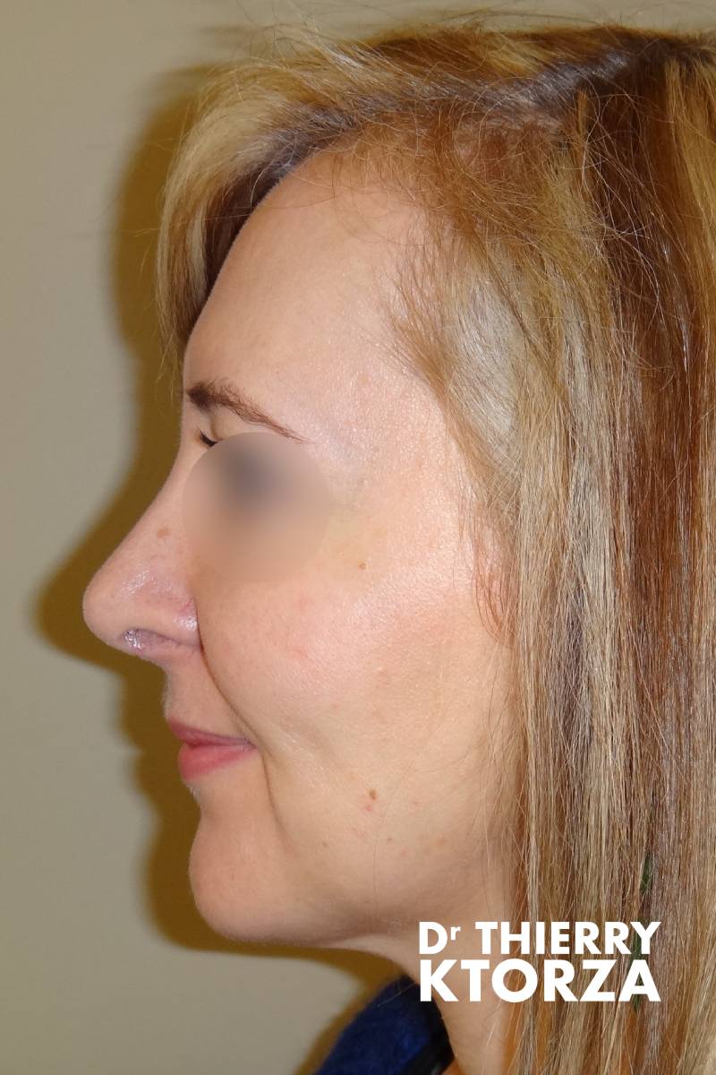 rhinoplastie senior apres