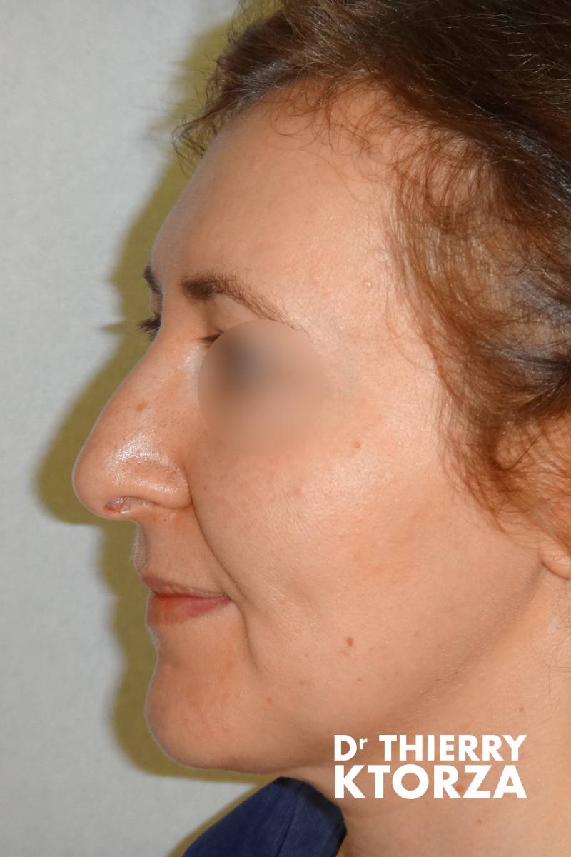 rhinoplastie senior avant
