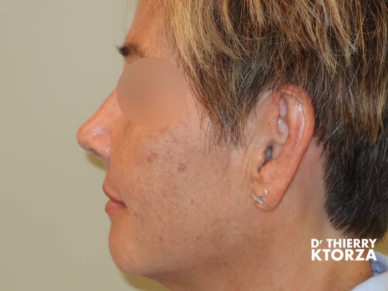 Patiente après une rhinoplastie classique (photo après, vue de face)