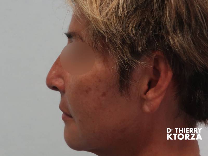 Patiente avant une rhinoplastie classique  (photo avant, vue de profil)