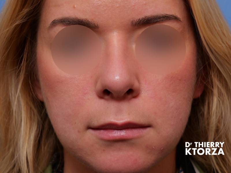 Patiente après une rhinoplastie médicale (photo après, vue de face)