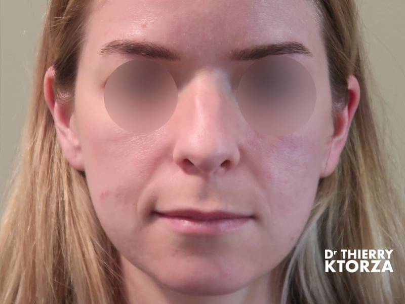 Patiente avant une rhinoplastie ultrasonique (photo avant, vue de face)