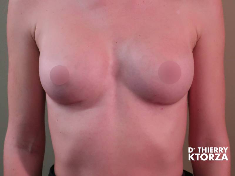 Photo après une pose d'une prothèse mammaire d'une taille supplémentaire (200 cc).