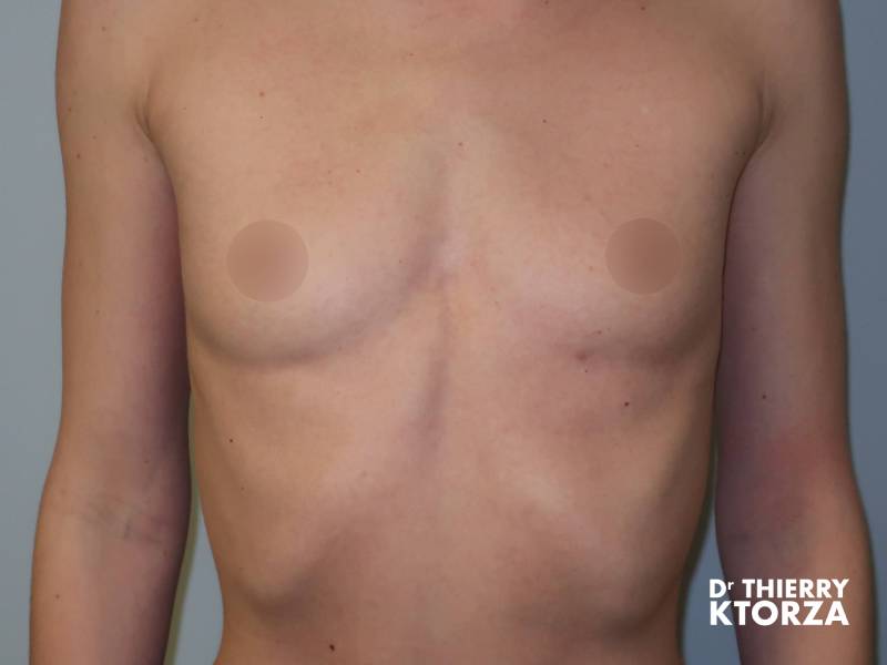 Photo avant une pose d'une prothèse mammaire d'une taille supplémentaire (200 cc).