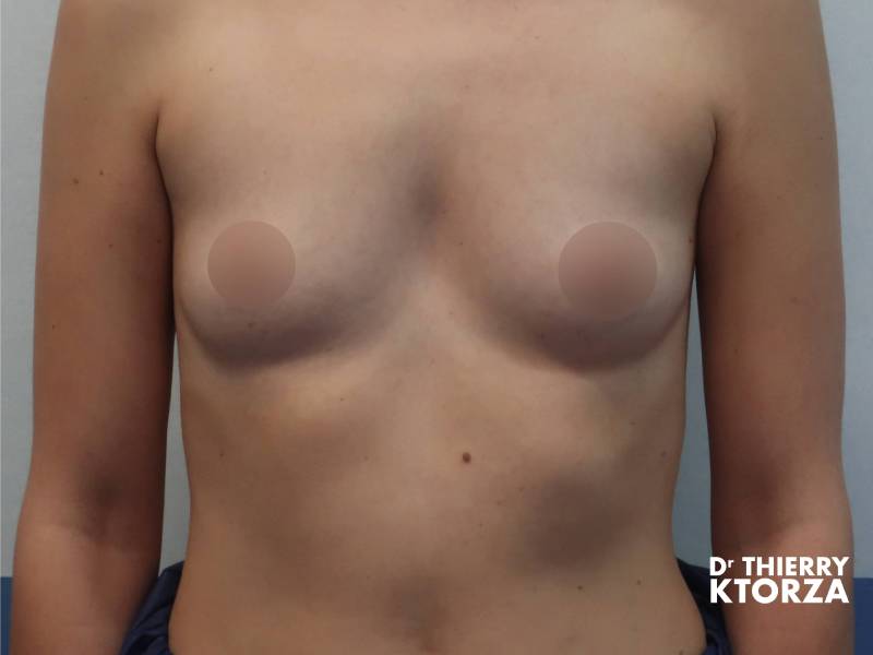Photo avant une pose d'une prothèse mammaire de 2 tailles supplémentaires (400 cc).