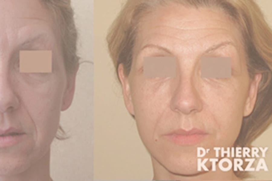 avant apres lifting du visage dr ktorza chirurgie esthetique paris avant apres lifting du visage dr ktorza chirurgie esthetique paris