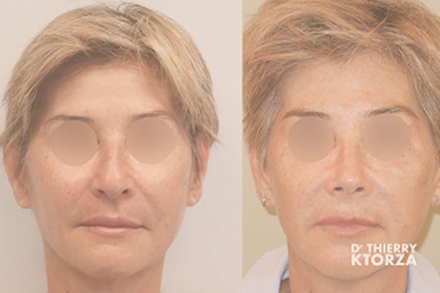 avant apres rhinoplastie dr ktorza chirurgie esthetique paris avant apres rhinoplastie dr ktorza chirurgie esthetique paris