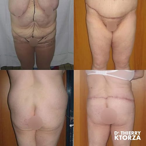 abdominoplastie photo avant apres dr ktorza 10 abdominoplastie photo avant apres dr ktorza 10