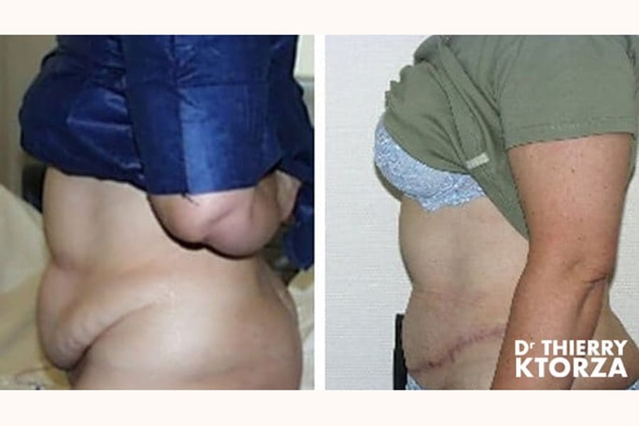 abdominoplastie photo avant apres dr ktorza 11 abdominoplastie photo avant apres dr ktorza 11