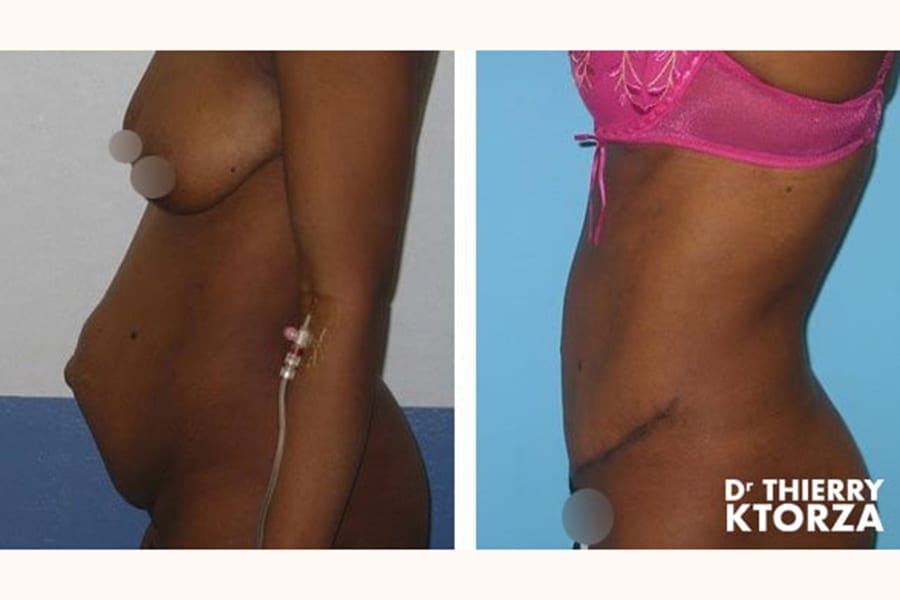 abdominoplastie photo avant apres dr ktorza 12 abdominoplastie photo avant apres dr ktorza 12