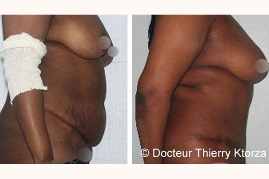 abdominoplastie-photo-avant-apres-dr-ktorza-13 abdominoplastie-photo-avant-apres-dr-ktorza-13
