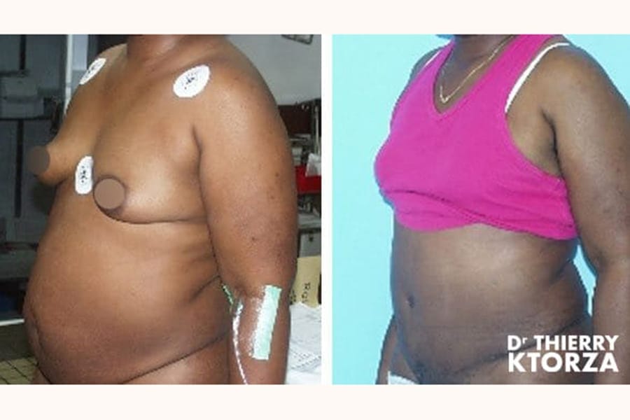 abdominoplastie-photo-avant-apres-dr-ktorza-14 abdominoplastie-photo-avant-apres-dr-ktorza-14