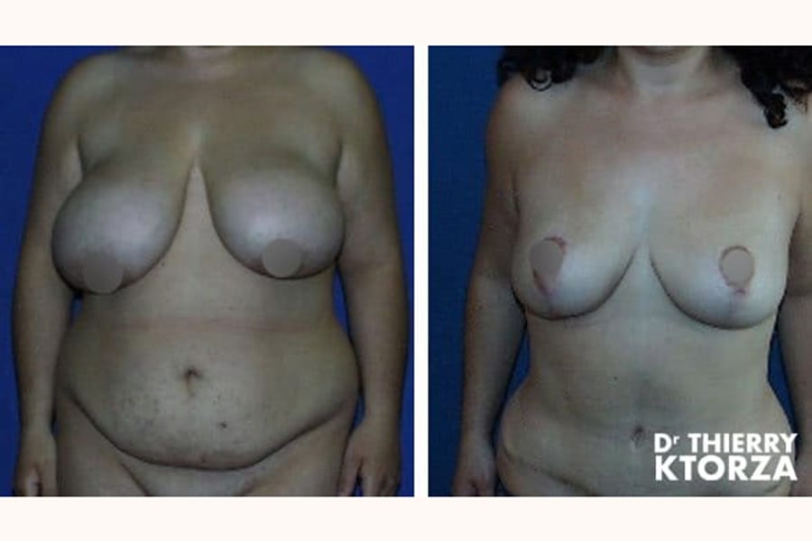 abdominoplastie-photo-avant-apres-dr-ktorza-15 abdominoplastie-photo-avant-apres-dr-ktorza-15